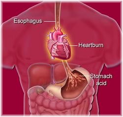 Heartburn - What Is Heartburn