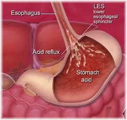 Acid Reflux Image